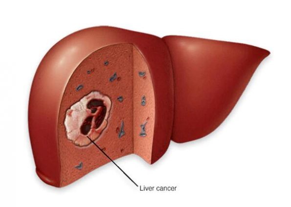 肝炎和肝癌——您需要知道的插图