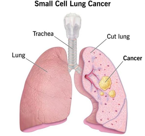 I – IIIA 期非小细胞肺癌的治疗插图