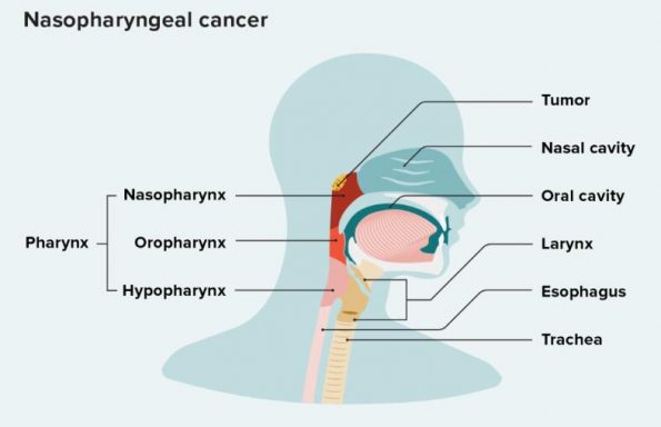 鼻咽癌：原因、症状和治疗插图