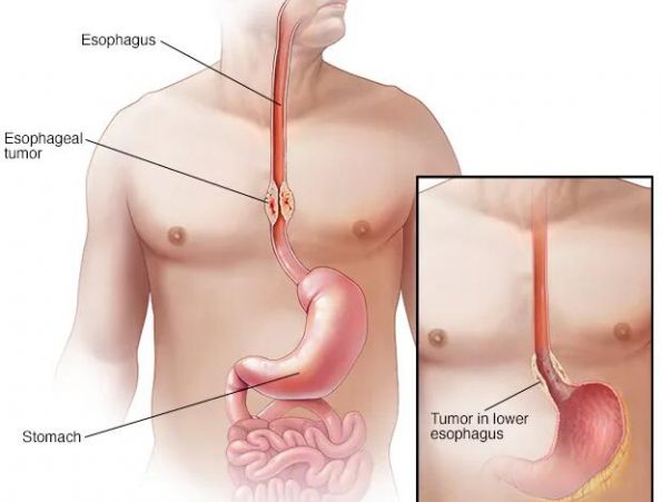 食管癌：原因、症状和治疗插图