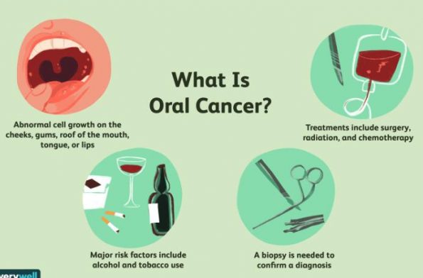 口腔癌：原因、症状和治疗插图