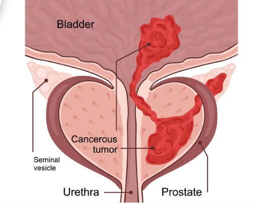 精囊癌：原因、症状和治疗插图