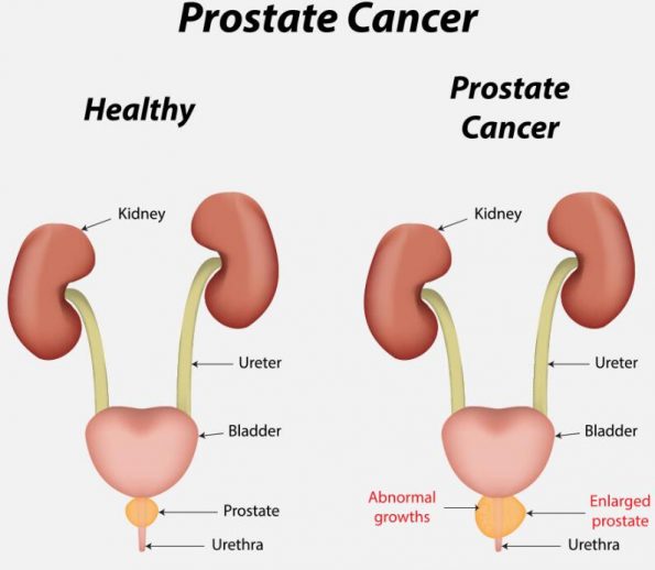 前列腺癌：原因、症状和治疗插图