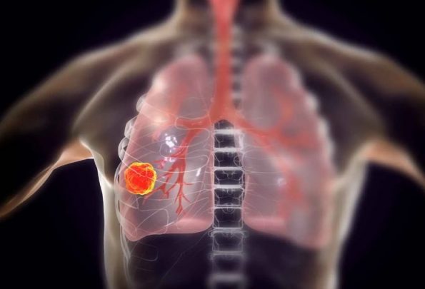 将 FZD4 纳米颗粒递送至肺内皮细胞可抑制肺癌进展和转移插图